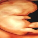 ダウン症を妊娠。中絶を恥じるべきではない理由とは？